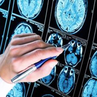 Nuova frontiera anti-Alzheimer: così si combattono le proteine tossiche